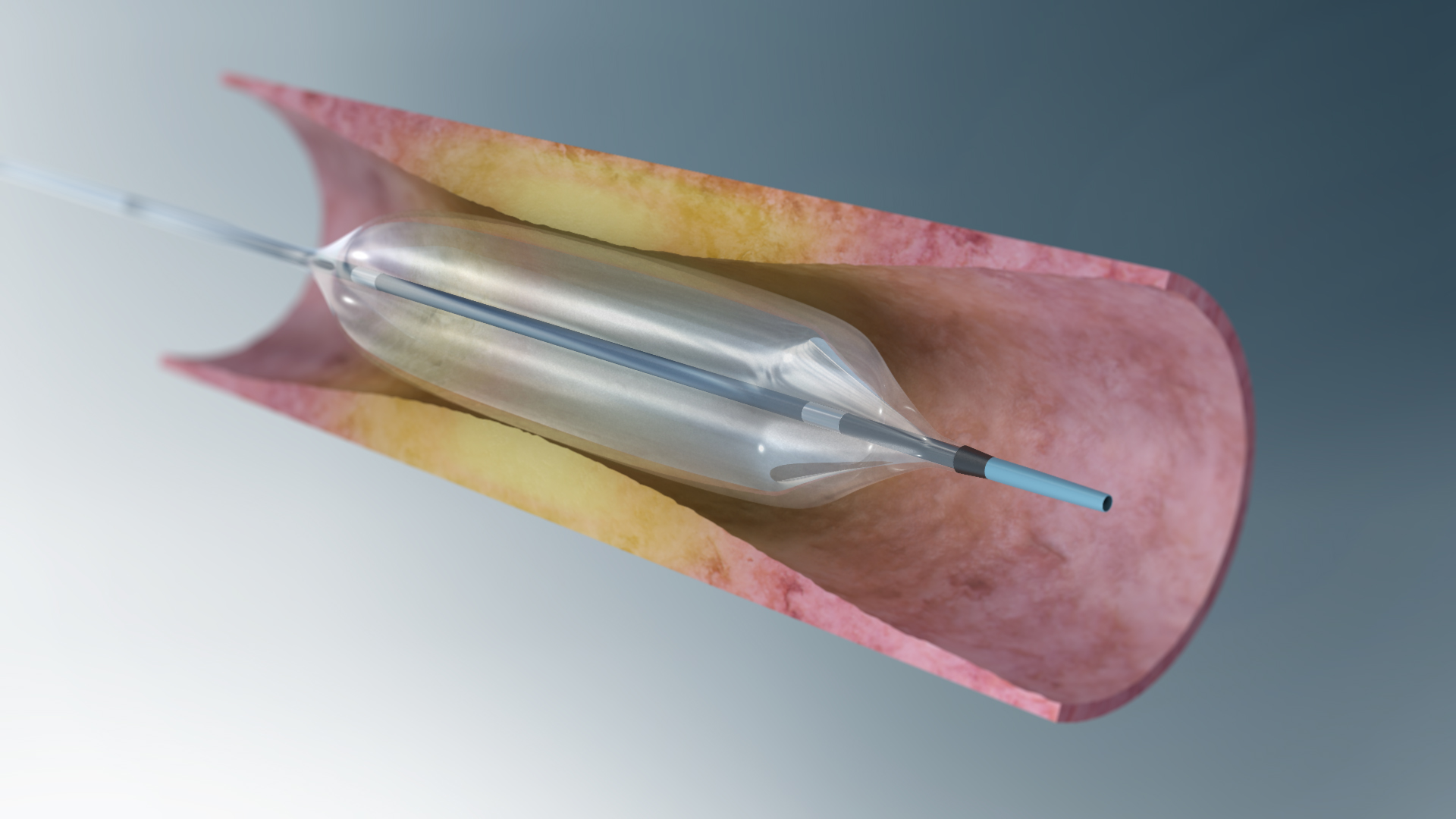 PTCA Balloon Catheter